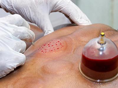 mokra_hijama.jpg